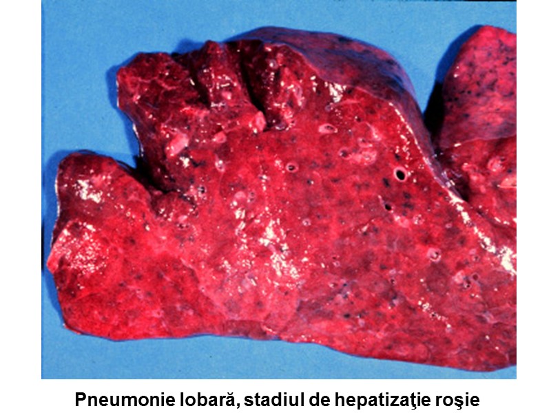 Pneumonie lobară, stadiul de hepatizaţie roşie